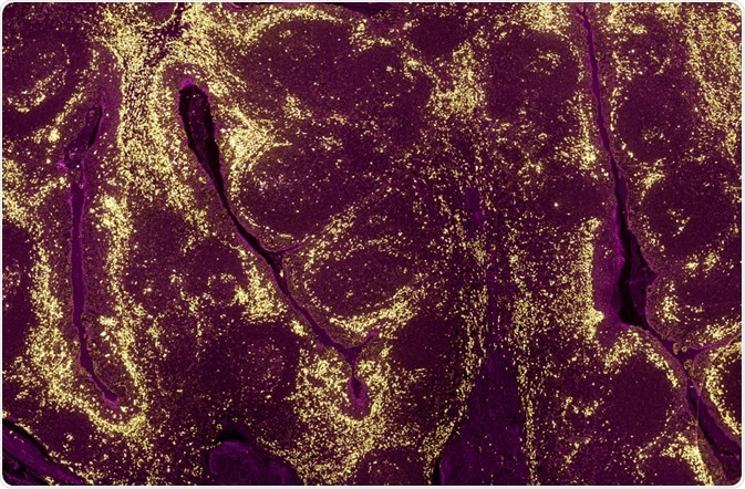 A tumour sample where the levels of different proteins in cell populations have been identified using a fluorescently labelled antibody - By Carl Dupont A tumour sample where the levels of different proteins in cell populations have been identified using a fluorescently labelled antibody - By Carl Dupont