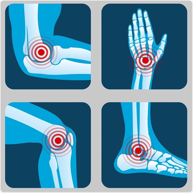 Joints that can be affected in arthritis - By MicroOne