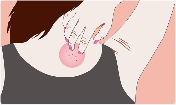 Ringworm on woman