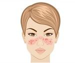 Lupus Diagnosis