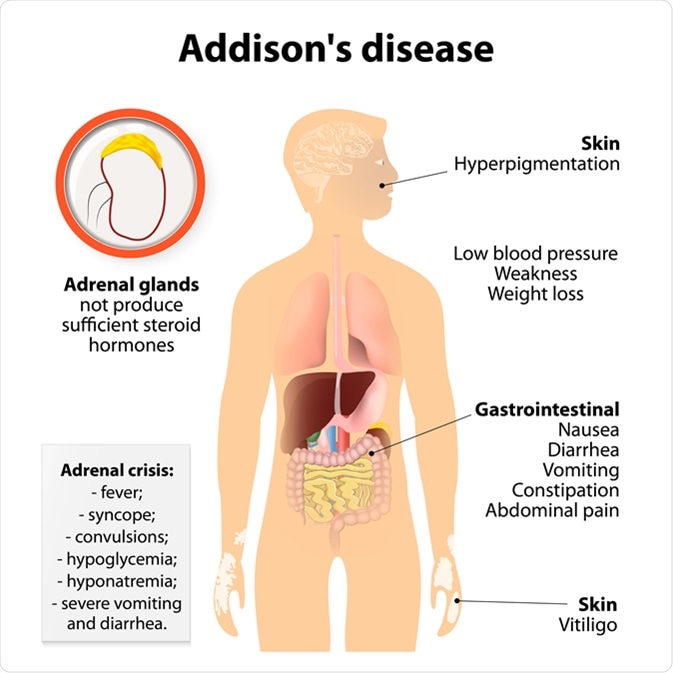 Addison