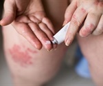 Eczema During Pregnancy