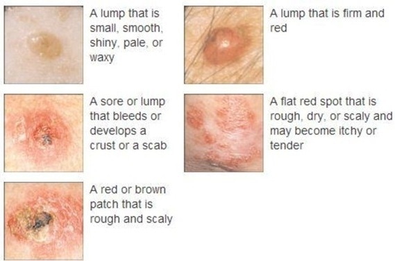 Symptoms associated with both basal cell and squamous cell carcinoma.