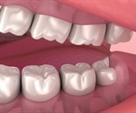 Wisdom Teeth Removal