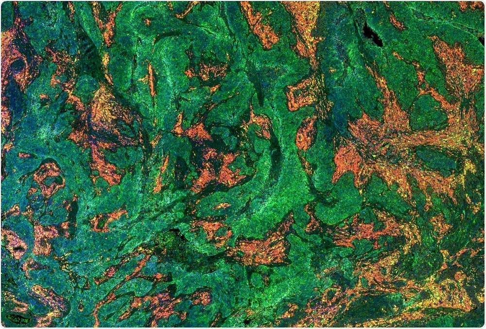 Tissue sample stained using multiple fluorescently labeled antibodies - image generated by Carl Dupont Tissue sample stained using multiple fluorescently labeled antibodies - image generated by Carl Dupont
