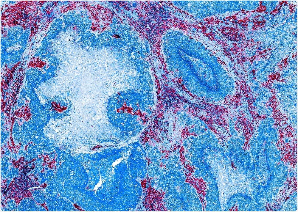 Tissue section that has undergone multicolor IHC to generate a pink, blue and purple image - by Carl Dupont Tissue section that has undergone multicolor IHC to generate a pink, blue and purple image - by Carl Dupont
