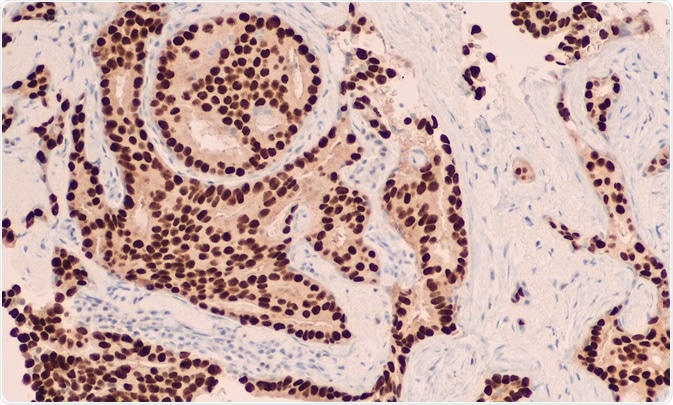 Breast cancer cells that have been visualized using immunohistochemistry (IHC) - photo taken By David Litman Breast cancer cells that have been visualized using immunohistochemistry (IHC) - photo taken By David Litman