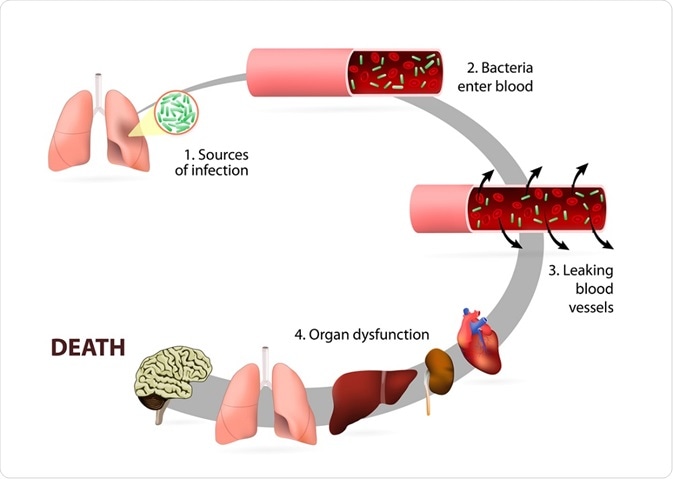 The stages of sepsis - a diagram - By Designua The stages of sepsis - a diagram - By Designua