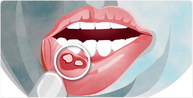 Stomatitis - By Naeblys Stomatitis - By Naeblys
