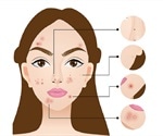 Acne Treatments