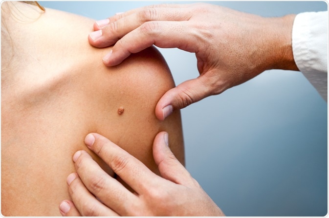 Person with suspected skin cancer - mole on skin that is being examined - a photo by damiangretka
