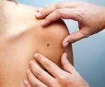 Skin Cancer Symptoms