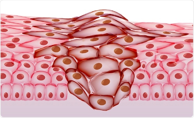 inbeve - cancer cells growing in epidermal tissue inbeve - cancer cells growing in epidermal tissue