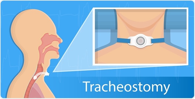 Diagram illustrating a tracheostomy - By rumrua Diagram illustrating a tracheostomy - By rumrua