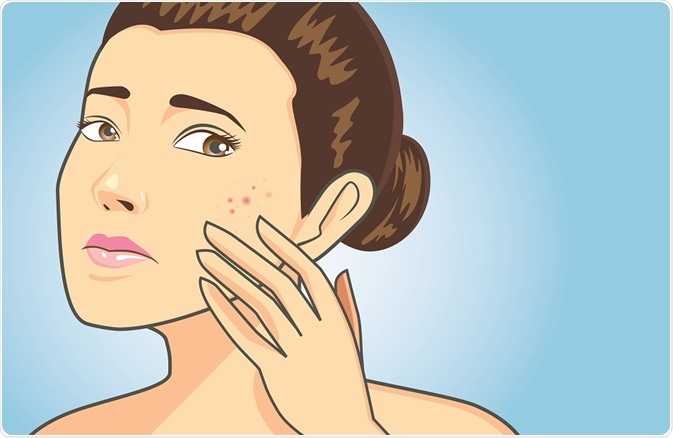Illustration of woman with acne scars - By solar22 Illustration of woman with acne scars - By solar22