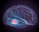 Low protein levels linked to posture and gait problems in Parkinson’s, finds study