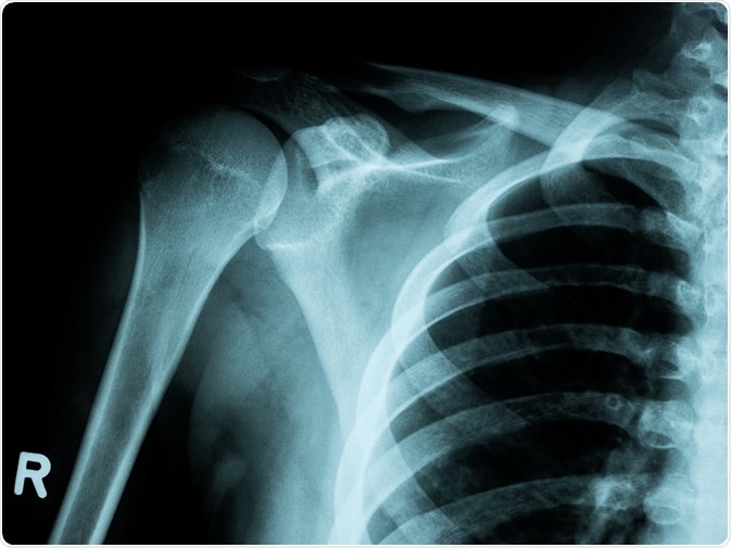 x-ray