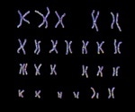 What is Patau Syndrome?