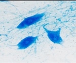 Discovery aids understanding of amyotrophic lateral sclerosis