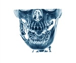 Odontogenic Keratocyst (OKC)