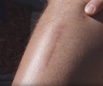 Compartment Syndrome Diagnosis