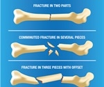 Broken Bone First Aid