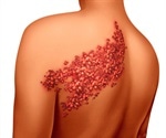 Shingles and Nerve Damage