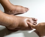 How is Aagenaes Syndrome Diagnosed?