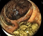Esophageal cancer risk could be reduced by esomeprazole and low dose aspirin