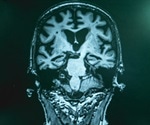 Biomarkers for Alzheimer's Disease