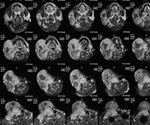 Gadolinium Deposition in the Brain