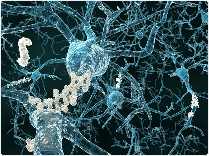 Alzheimer