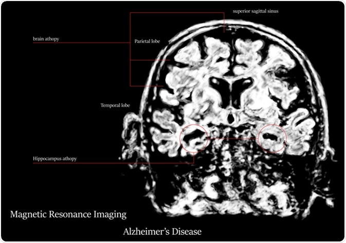 Alzheimer