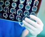 Using Imaging Techniques to Assess the Effects of a Stroke