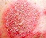 Nummular Dermatitis Management