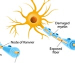 Anti-Myelin Antibodies in Multiple Sclerosis