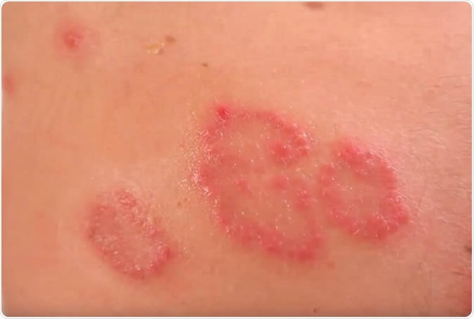 Nummular dermatitis is a form of eczema, also referred to as nummular eczema or discoid eczema, which occurs most often in older men between the ages of 55 – 65.