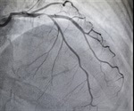 Single antiplatelet therapy after TAVR linked to lower mortality and bleeding