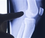 Interferon pathway genes linked to treatment success in juvenile arthritis