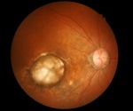 Diabetic eye disease on the rise