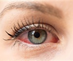 NIH awards major grant to advance mucormycosis research