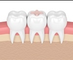 The Advantages of Using Glass Ionomers in Dentistry