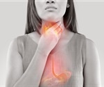 Researchers develop a digital tool to better monitor Barrett's esophagus