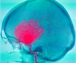 EMA designates allopurinol as first orphan drug for the treatment of Marfan syndrome