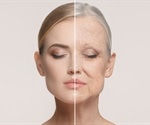 New brain scan tool predicts aging speed and dementia risk