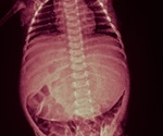 Causes of Abdominal Distension