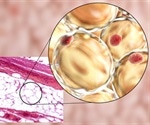 Adipose Expandability Hypothesis