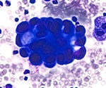 Organ chip technology accurately predicts chemotherapy response in esophageal adenocarcinoma patients