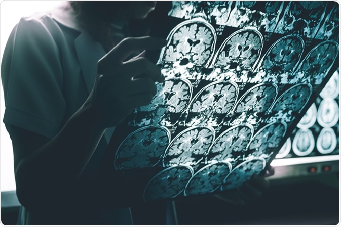 Alzheimer