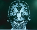 Mixed Dementia Symptoms and Diagnosis
